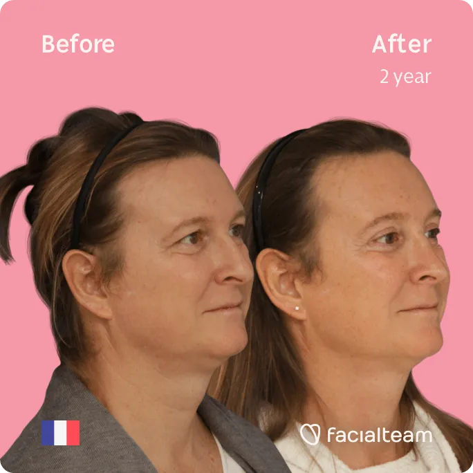 Square 45 degree image of FFS patient Anne showing the results before and after facial feminization surgery consisting of forehead, rhinoplasty feminization surgery.