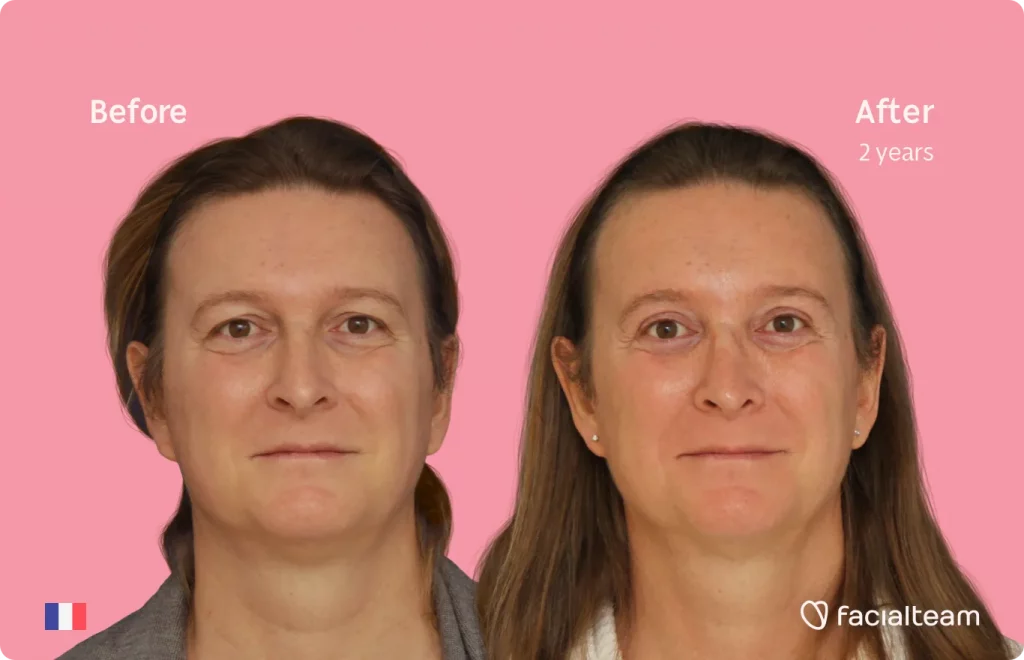 Frontal image of FFS patient Anne showing the results before and after facial feminization surgery with Facialteam consisting of forehead, rhinoplasty feminization surgery.