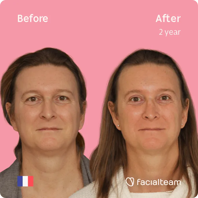 Square frontal image of FFS patient Anne showing the results before and after facial feminization surgery with Facialteam consisting of forehead, rhinoplasty feminization surgery.