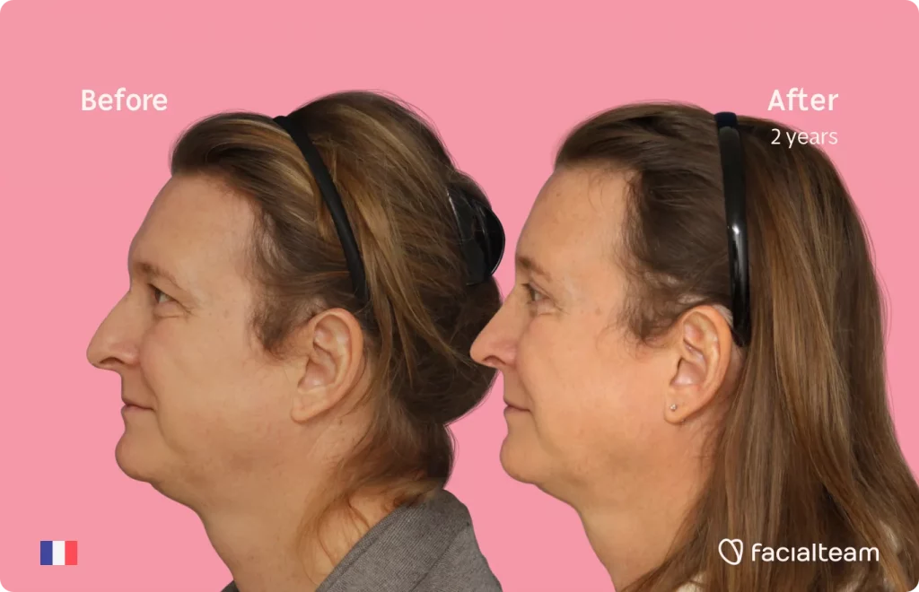 Side image of FFS patient Anne showing the results before and after facial feminization surgery with Facialteam consisting of forehead, rhinoplasty feminization surgery.