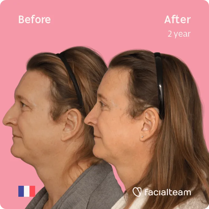 Square Side image of FFS patient Anne showing the results before and after facial feminization surgery with Facialteam consisting of forehead, rhinoplasty feminization surgery.