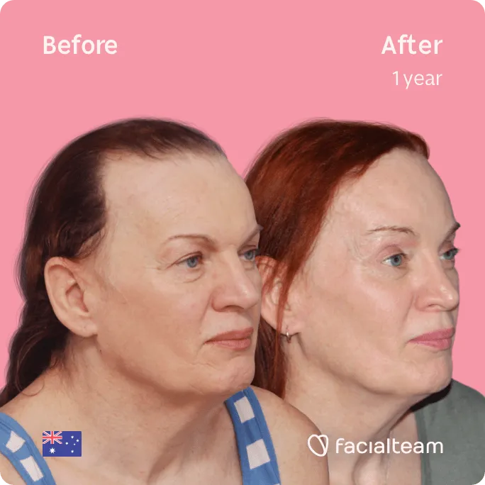 Square 45 degree image of FFS patient Brenna showing the results before and after facial feminization surgery consisting of forehead, rhinoplasty feminization surgery.