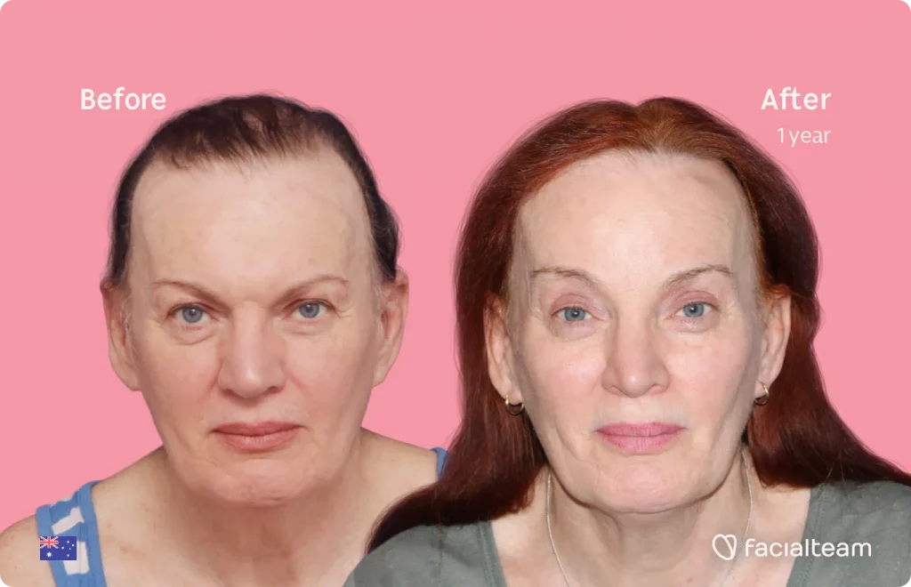 Frontal image of FFS patient Brenna showing the results before and after facial feminization surgery with Facialteam consisting of forehead, rhinoplasty feminization surgery.