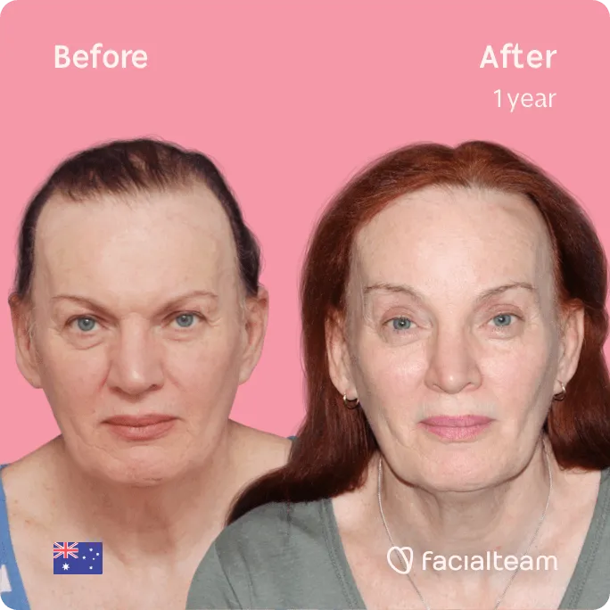 Square frontal image of FFS patient Brenna showing the results before and after facial feminization surgery with Facialteam consisting of forehead, rhinoplasty feminization surgery.