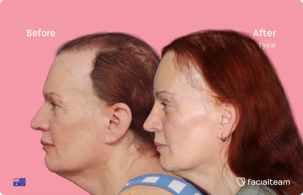 Side image of FFS patient Brenna showing the results before and after facial feminization surgery with Facialteam consisting of forehead, rhinoplasty feminization surgery.