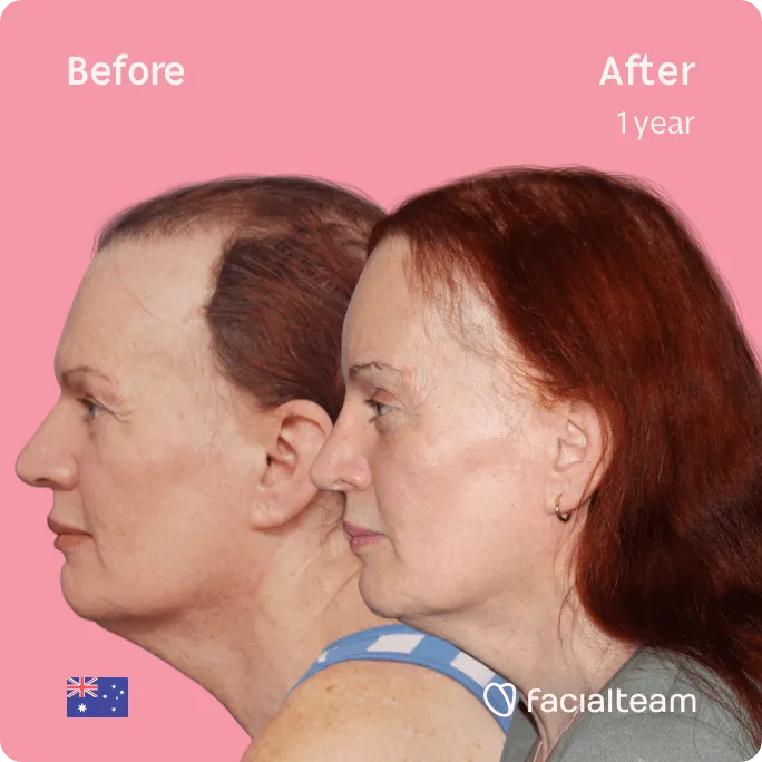 Square Side image of FFS patient Brenna showing the results before and after facial feminization surgery with Facialteam consisting of forehead, rhinoplasty feminization surgery.