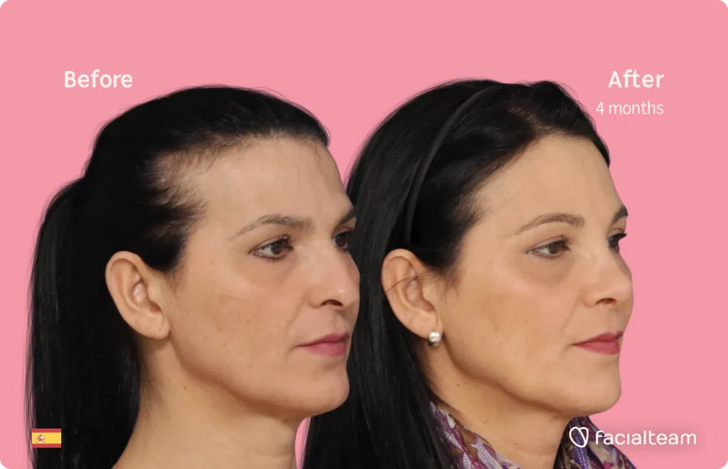 45 degree image of FFS patient Carmen showing the results before and after facial feminization surgery consisting of forehead, rhinoplasty feminization surgery.