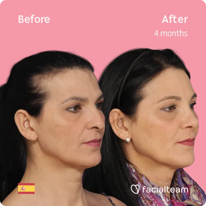 Square 45 degree image of FFS patient Carmen showing the results before and after facial feminization surgery consisting of forehead, rhinoplasty feminization surgery.