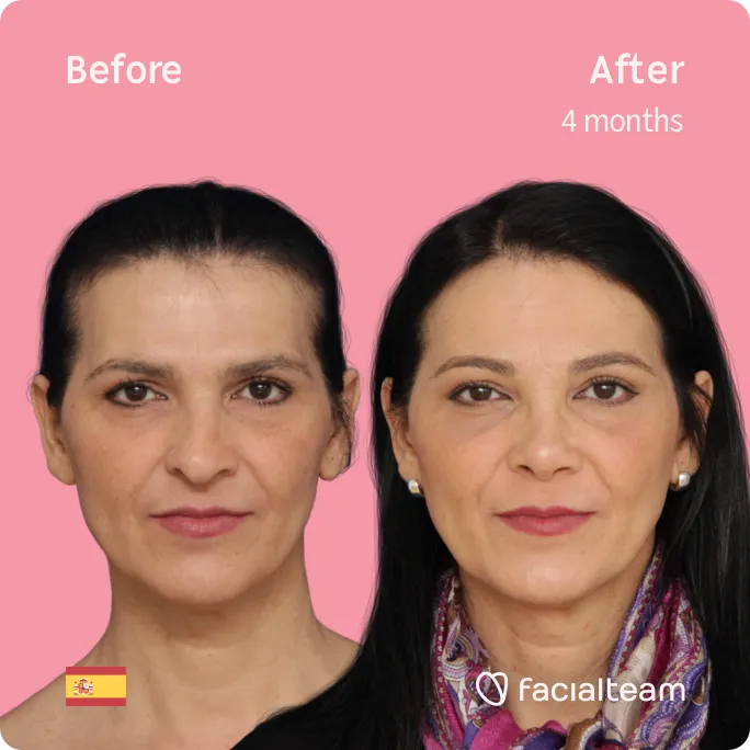 Square frontal image of FFS patient Carmen showing the results before and after facial feminization surgery with Facialteam consisting of forehead, rhinoplasty feminization surgery.