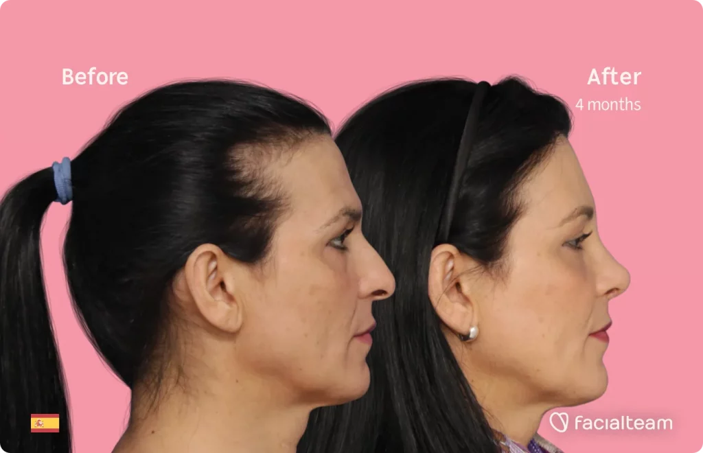 Side image of FFS patient Carmen showing the results before and after facial feminization surgery with Facialteam consisting of forehead, rhinoplasty feminization surgery.