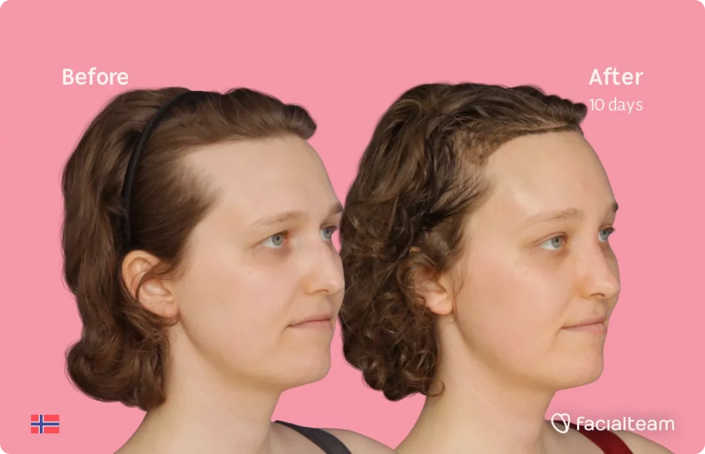 45 degree image of FFS patient Gina showing the results before and after facial feminization surgery consisting of forehead, rhinoplasty feminization surgery.