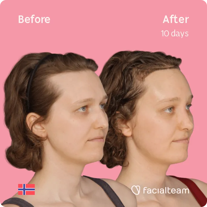 Square 45 degree image of FFS patient Gina showing the results before and after facial feminization surgery consisting of forehead, rhinoplasty feminization surgery.