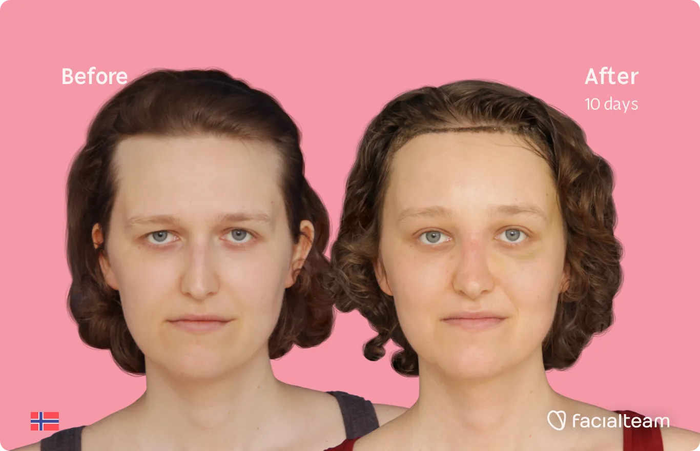 Frontal image of FFS patient Gina showing the results before and after facial feminization surgery with Facialteam consisting of forehead, rhinoplasty feminization surgery.