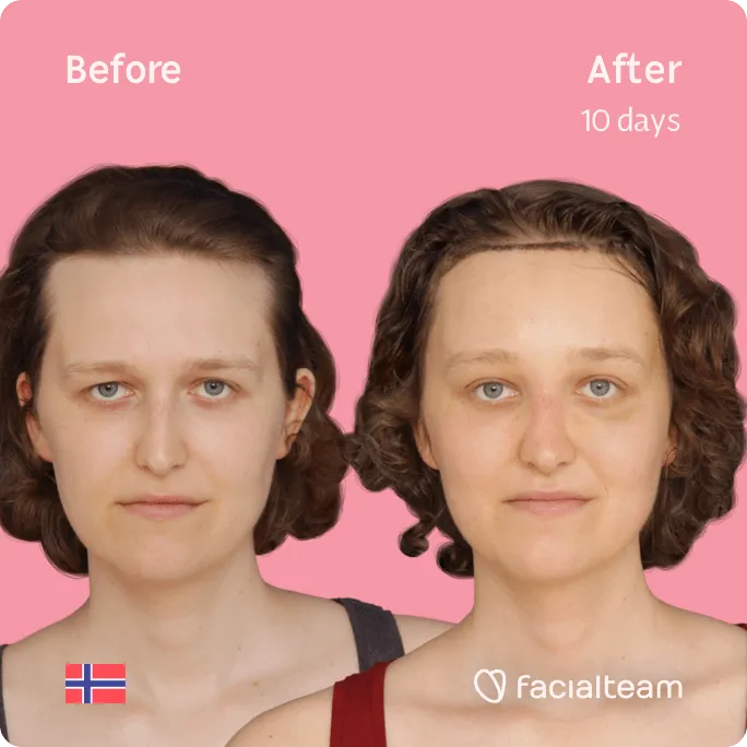 Square frontal image of FFS patient Gina showing the results before and after forehead reduction surgery combined with a hair transplant.