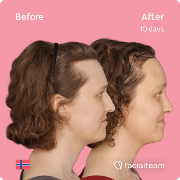 Square Side image of FFS patient Gina showing the results before and after facial feminization surgery with Facialteam consisting of forehead, rhinoplasty feminization surgery.