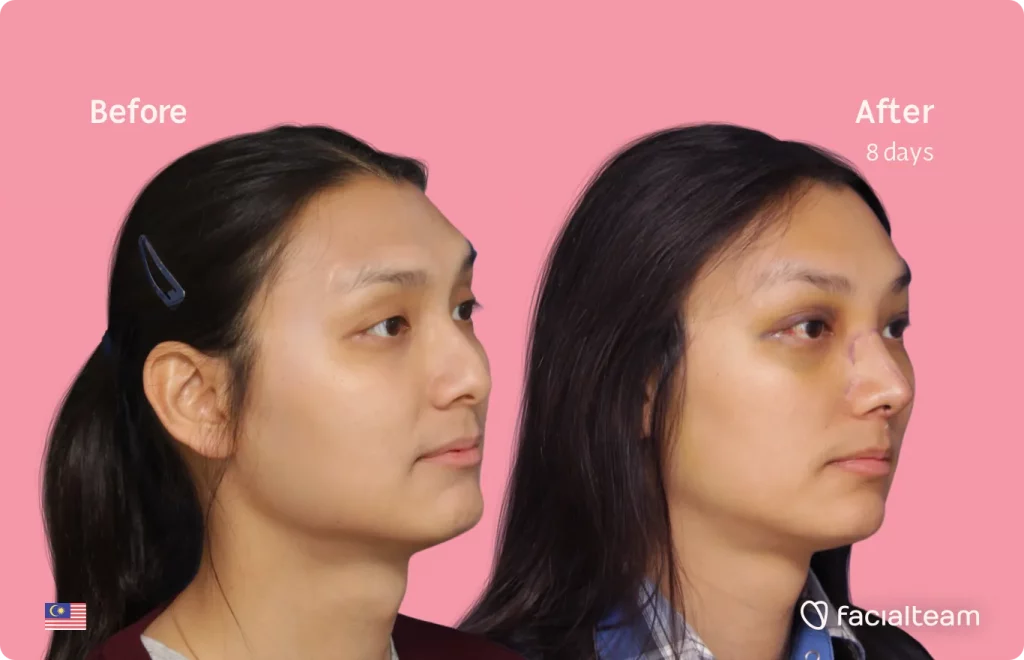 45 degree image of FFS patient Samantha showing the results before and after facial feminization surgery consisting of forehead, rhinoplasty feminization surgery.