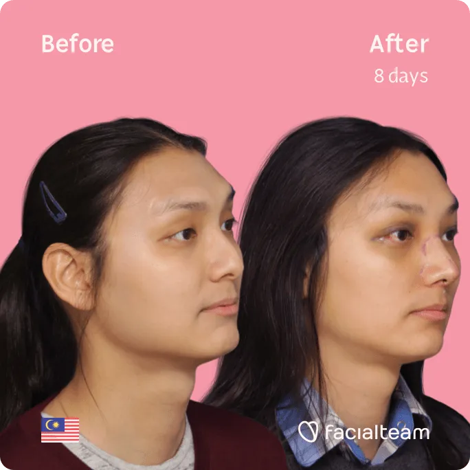 Square 45 degree image of FFS patient Samantha showing the results before and after facial feminization surgery consisting of forehead, rhinoplasty feminization surgery.