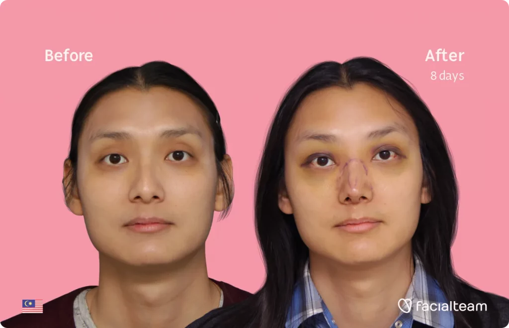 Square Side image of FFS patient Saga showing the results before and after facial feminization surgery with Facialteam consisting of forehead, jaw and chin, rhinoplasty, traquea shave feminization surgery.