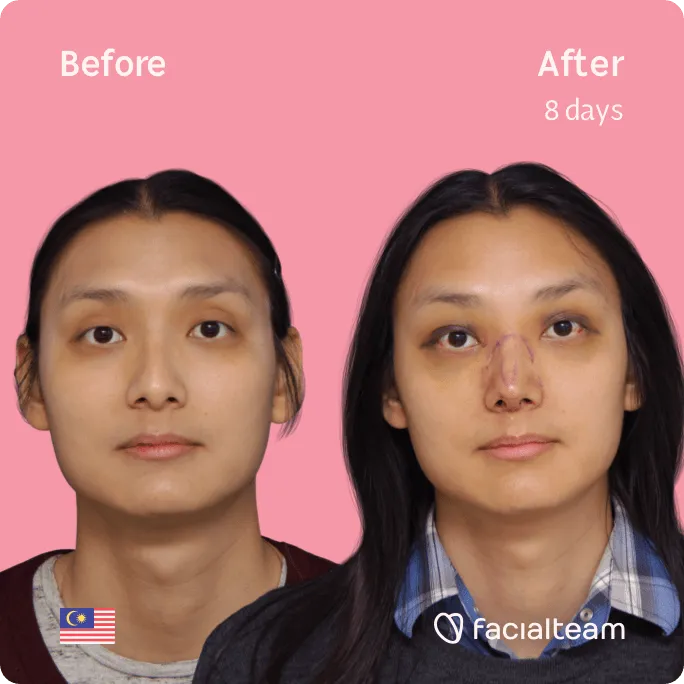 Square frontal image of FFS patient Samantha showing the results before and after facial feminization surgery with Facialteam consisting of forehead, rhinoplasty feminization surgery.