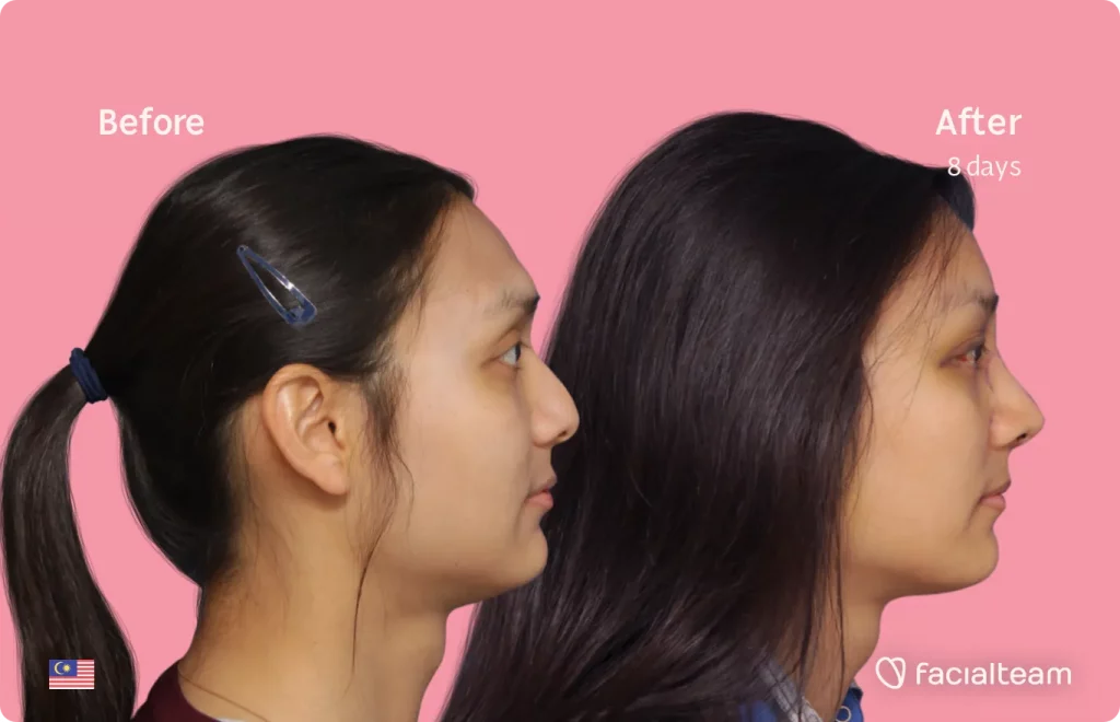 Side image of FFS patient Samantha showing the results before and after facial feminization surgery with Facialteam consisting of forehead, rhinoplasty feminization surgery.
