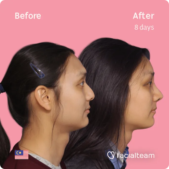 Square Side image of FFS patient Samantha showing the results before and after facial feminization surgery with Facialteam consisting of forehead, rhinoplasty feminization surgery.
