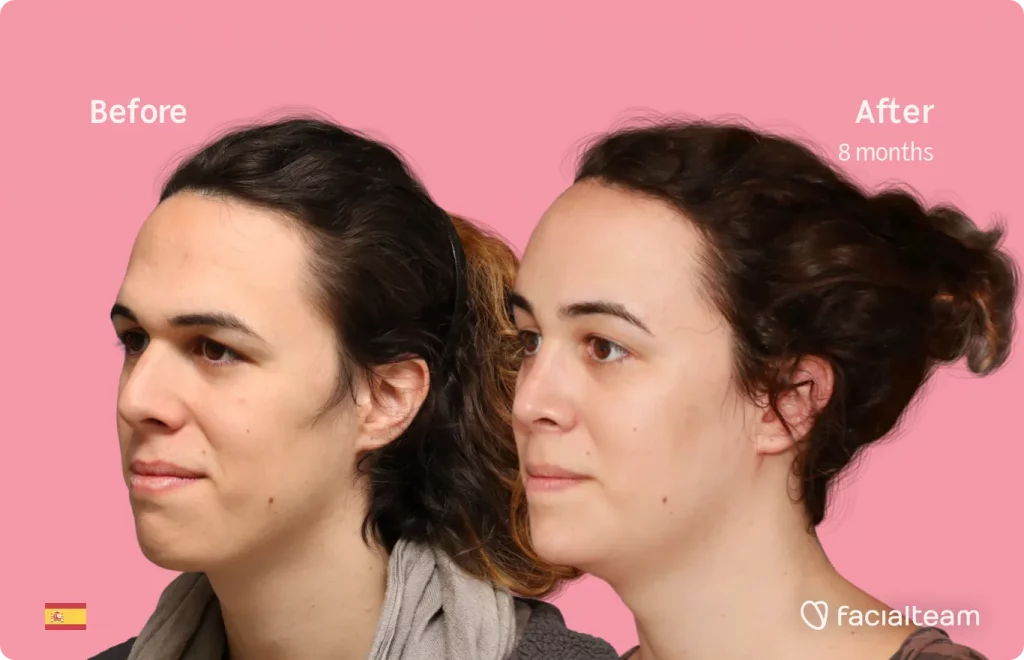 45 degree image of FFS patient June showing the results before and after facial feminization surgery consisting of forehead, rhinoplasty, jaw and chin feminization surgery.
