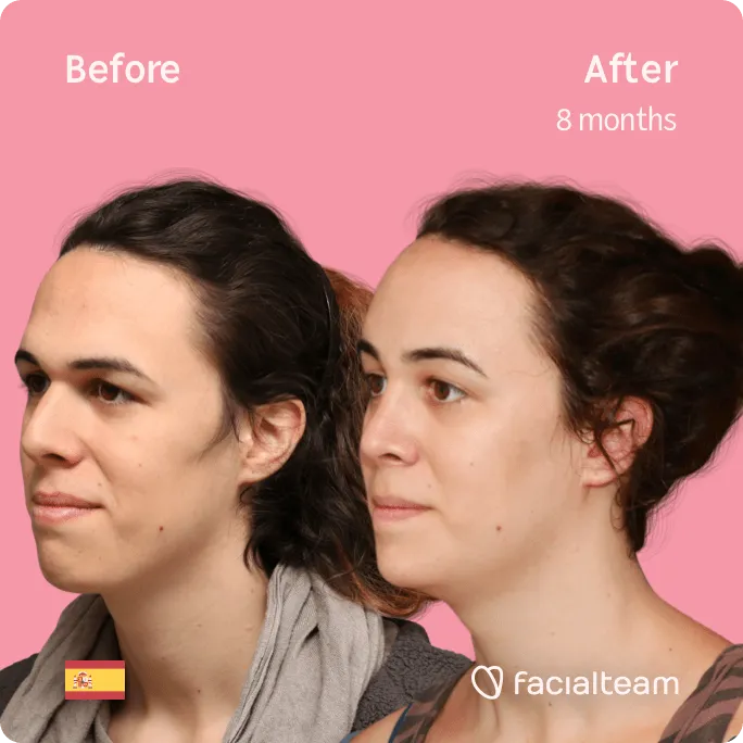 Square 45 degree image of FFS patient June showing the results before and after facial feminization surgery consisting of forehead, rhinoplasty, jaw and chin feminization surgery.