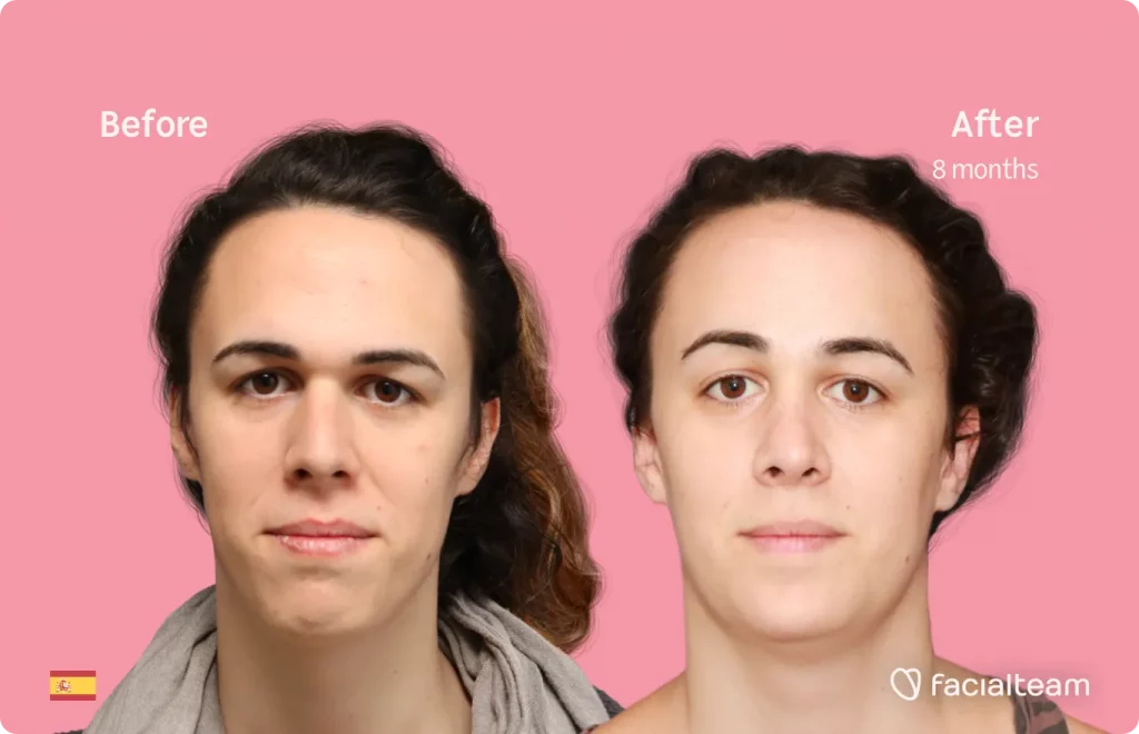 Frontal image of FFS patient June showing the results before and after facial feminization surgery with Facialteam consisting of forehead, rhinoplasty, jaw and chin feminization surgery.