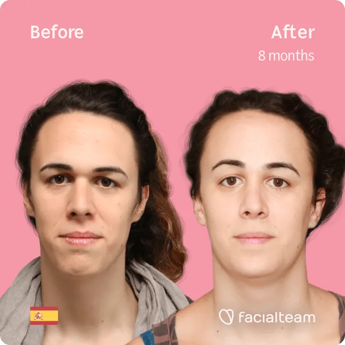 Square frontal image of FFS patient June showing the results before and after facial feminization surgery with Facialteam consisting of forehead, rhinoplasty, jaw and chin feminization surgery.