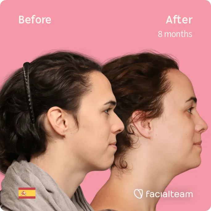Square Side image of FFS patient June showing the results before and after facial feminization surgery with Facialteam consisting of forehead, rhinoplasty, jaw and chin feminization surgery.