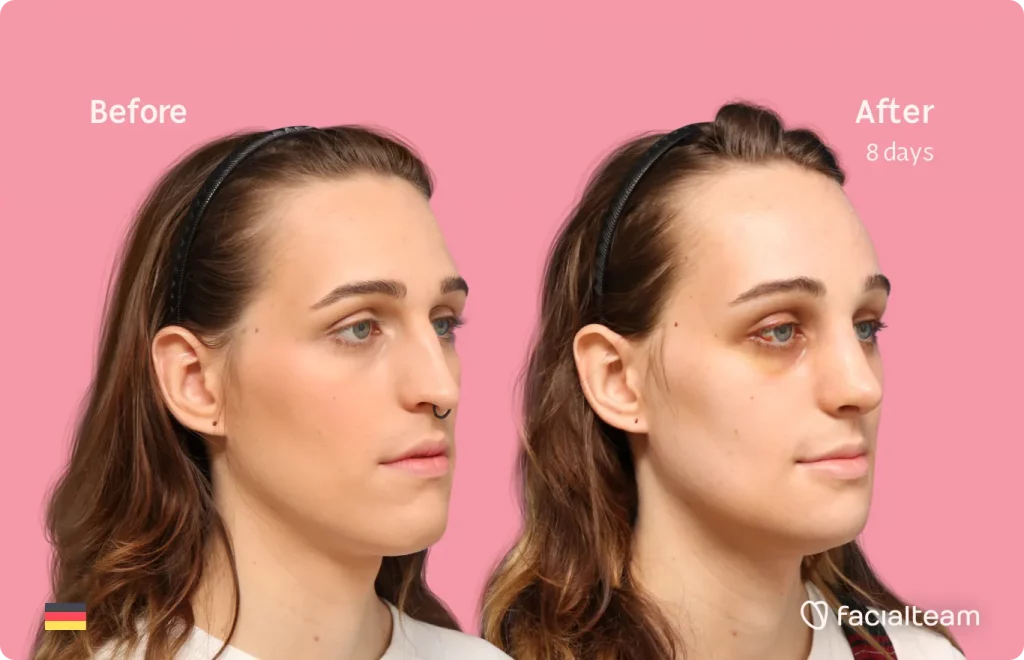 45 degree image of FFS patient Micah showing the results before and after facial feminization surgery consisting of forehead, rhinoplasty, jaw and chin feminization surgery.