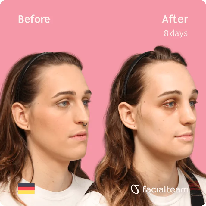 Square 45 degree image of FFS patient Micah showing the results before and after facial feminization surgery consisting of forehead, rhinoplasty, jaw and chin feminization surgery.