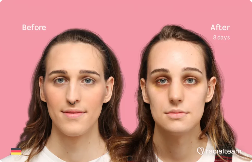 Frontal image of FFS patient Micah showing the results before and after facial feminization surgery with Facialteam consisting of forehead, rhinoplasty, jaw and chin feminization surgery.