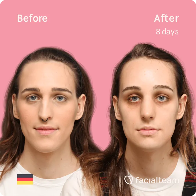 Square frontal image of FFS patient Micah showing the results before and after facial feminization surgery with Facialteam consisting of forehead, rhinoplasty, jaw and chin feminization surgery.