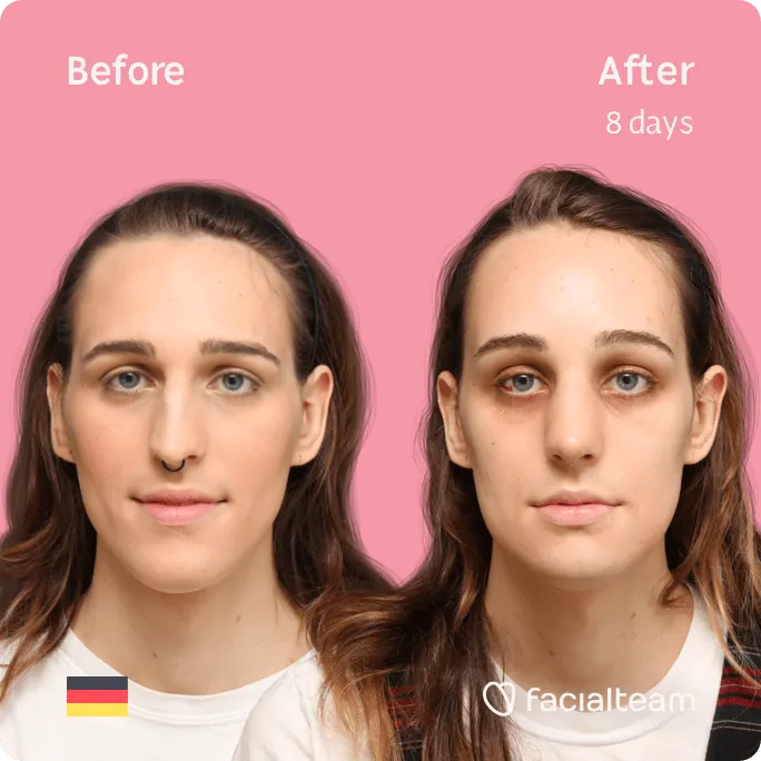 Jaw Reduction in Facial Feminization Surgery for Transwomen