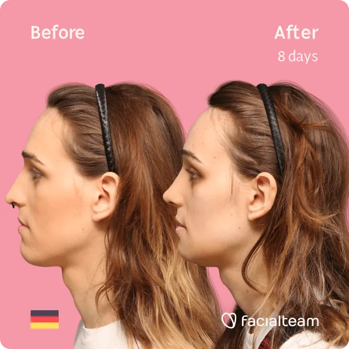 Square Side image of FFS patient Micah showing the results before and after facial feminization surgery with Facialteam consisting of forehead, rhinoplasty, jaw and chin feminization surgery.