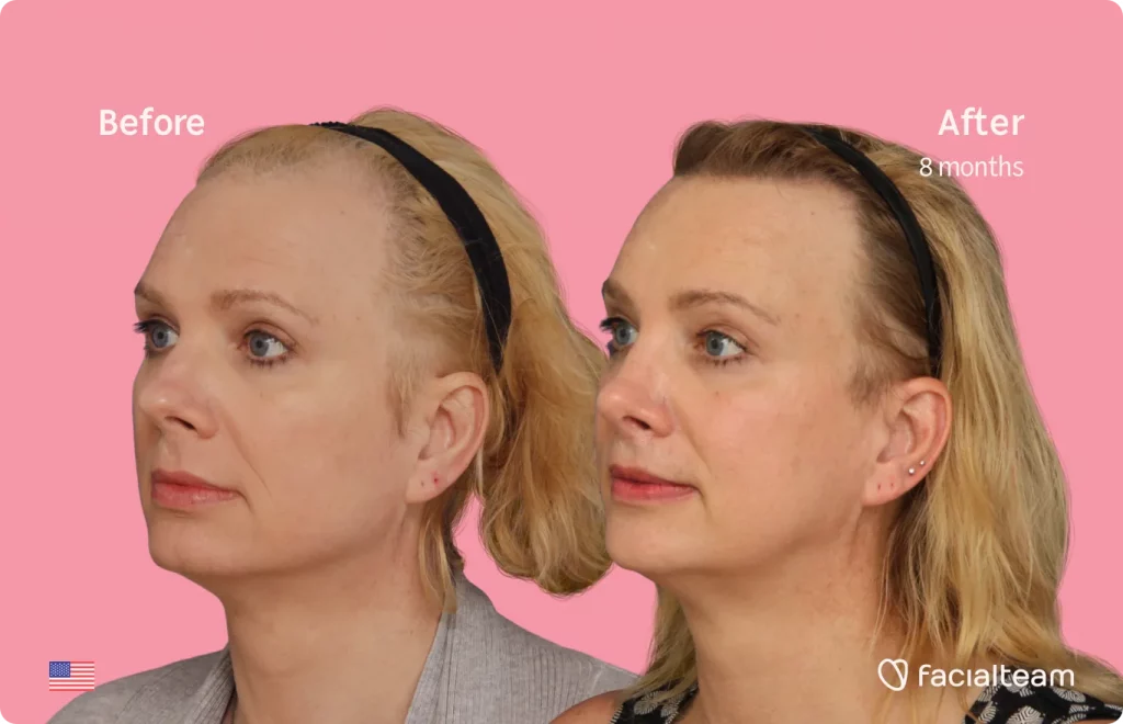 45 degree image of FFS patient Charlotte K showing the results before and after facial feminization surgery consisting of forehead, rhinoplasty, jaw and chin, lip feminization surgery.