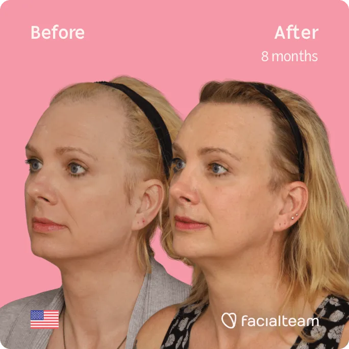 Square 45 degree image of FFS patient Charlotte K showing the results before and after facial feminization surgery consisting of forehead, rhinoplasty, jaw and chin, lip feminization surgery.