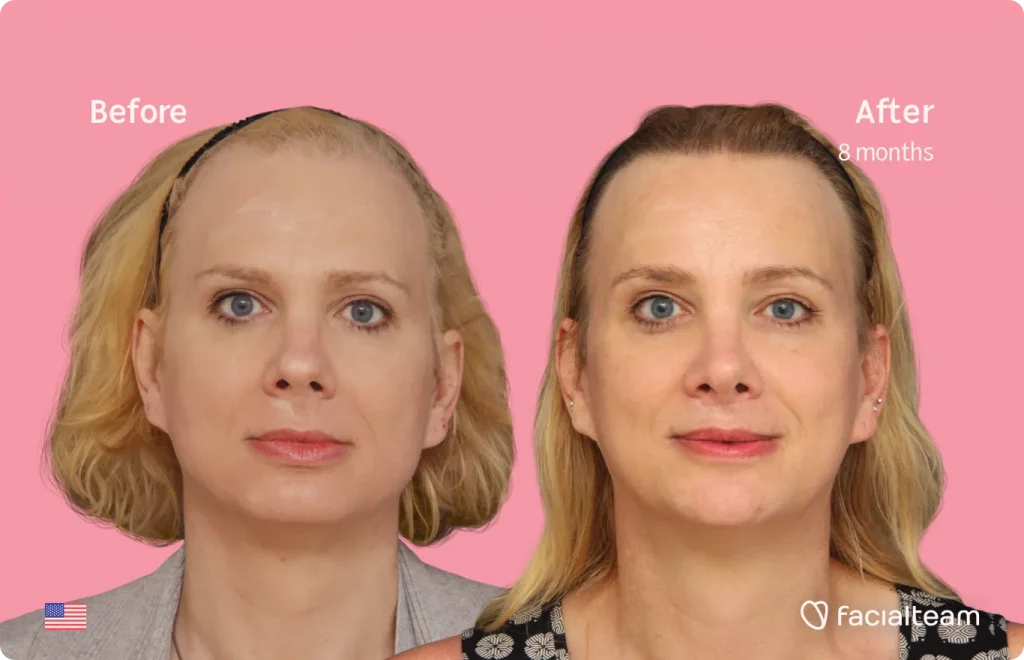 Frontal image of FFS patient Charlotte K showing the results before and after facial feminization surgery with Facialteam consisting of forehead, rhinoplasty, jaw and chin, lip feminization surgery.