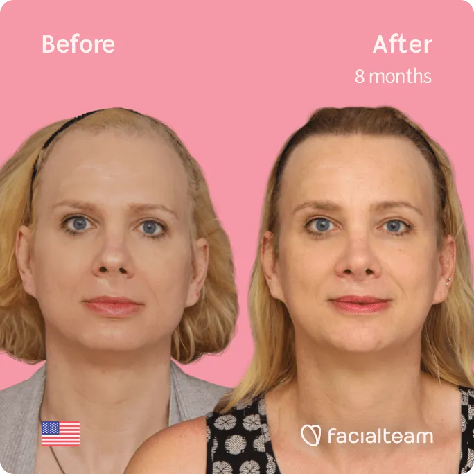 Square frontal image of FFS patient Charlotte K showing the results before and after facial feminization surgery with Facialteam consisting of forehead, rhinoplasty, jaw and chin, lip feminization surgery.