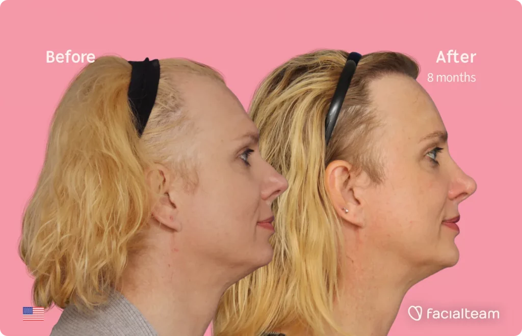 Side image of FFS patient Charlotte K showing the results before and after facial feminization surgery with Facialteam consisting of forehead, rhinoplasty, jaw and chin, lip feminization surgery.