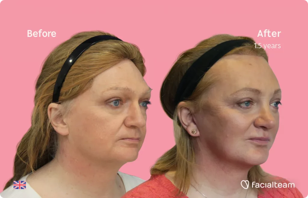 45 degree image of FFS patient Merryn showing the results before and after facial feminization surgery consisting of forehead, rhinoplasty, jaw and chin, lip feminization surgery.