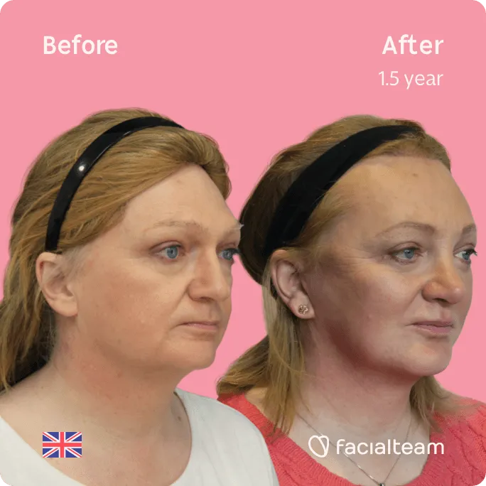 Square 45 degree image of FFS patient Merryn showing the results before and after facial feminization surgery consisting of forehead, rhinoplasty, jaw and chin, lip feminization surgery.