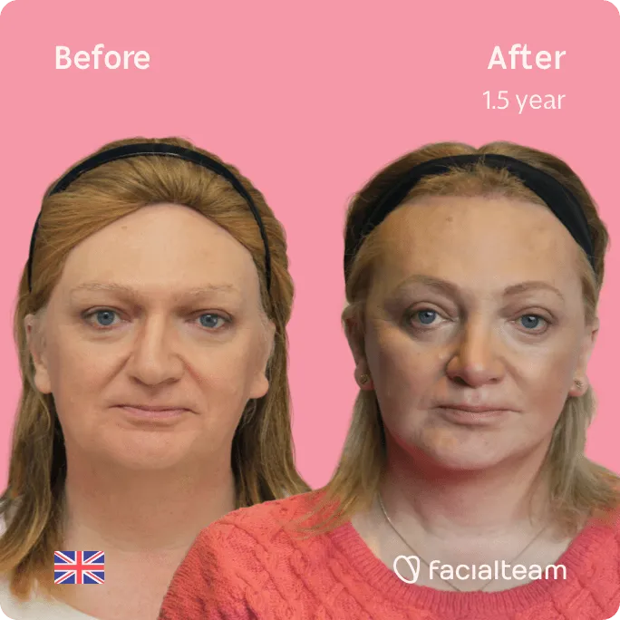 Square frontal image of FFS patient Merryn showing the results before and after facial feminization surgery with Facialteam consisting of forehead, rhinoplasty, jaw and chin, lip feminization surgery.