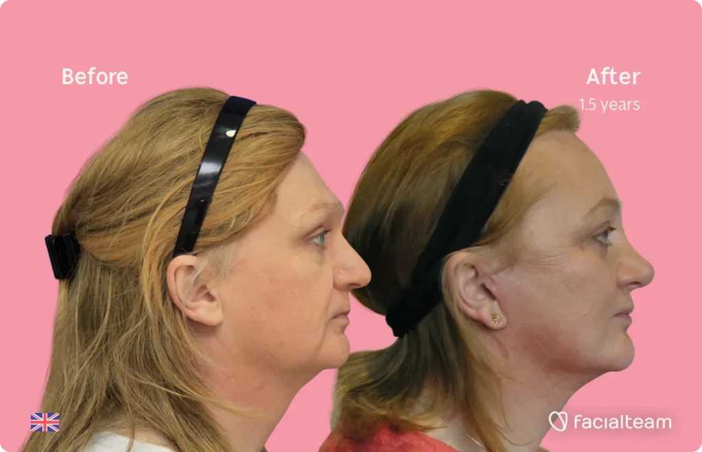 Side image of FFS patient Merryn showing the results before and after facial feminization surgery with Facialteam consisting of forehead, rhinoplasty, jaw and chin, lip feminization surgery.