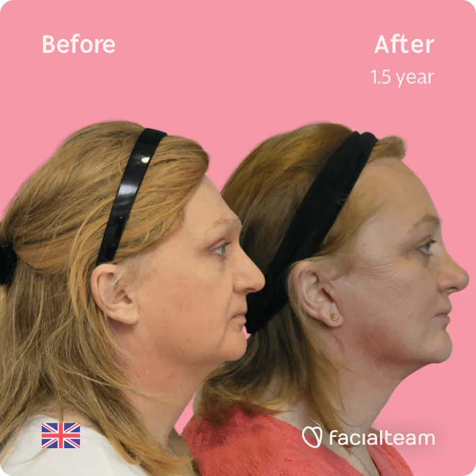 Square Side image of FFS patient Merryn showing the results before and after facial feminization surgery with Facialteam consisting of forehead, rhinoplasty, jaw and chin, lip feminization surgery.
