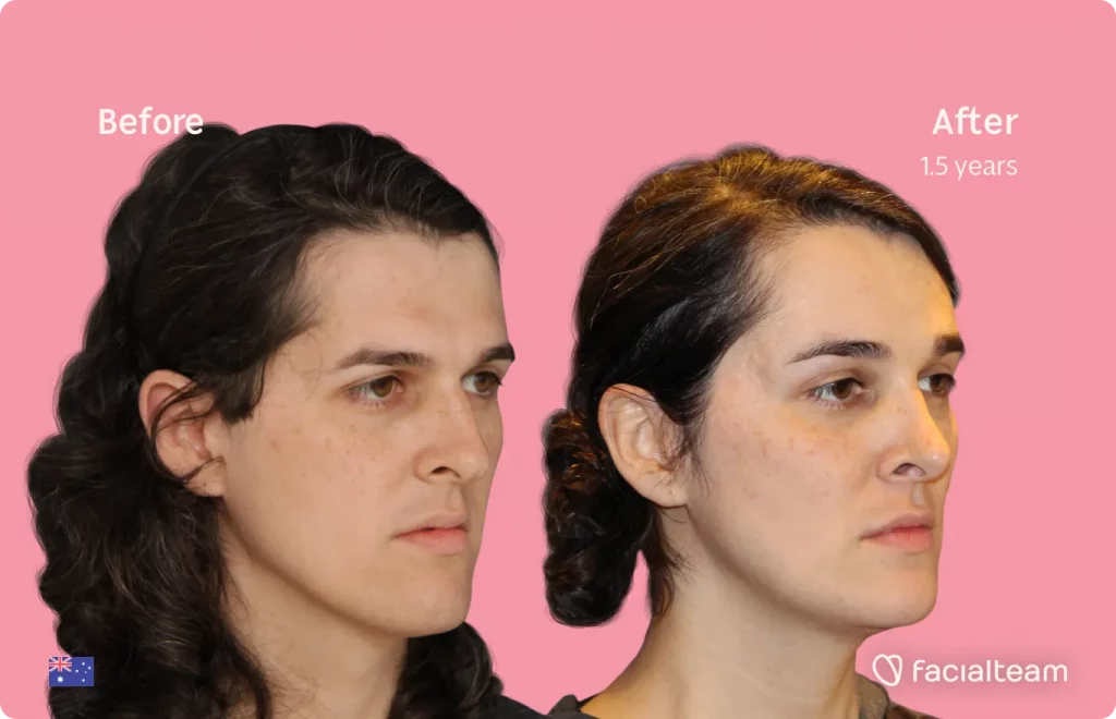 45 degree image of FFS patient Allison showing the results before and after facial feminization surgery consisting of forehead, rhinoplasty, jaw and chin, tracheal shave feminization surgery.