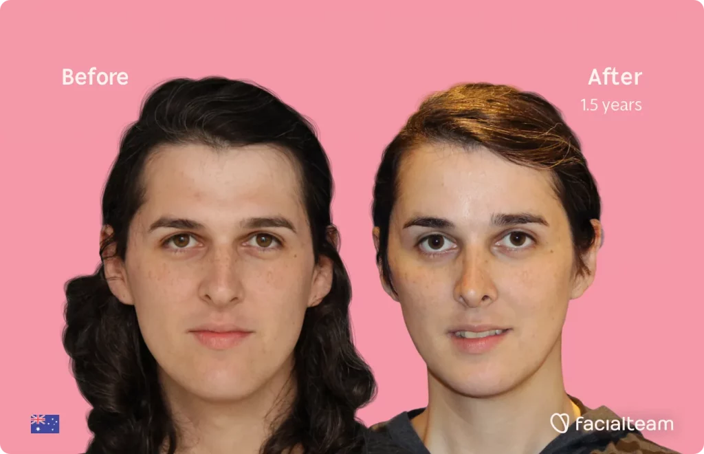 Frontal image of FFS patient Allison showing the results before and after facial feminization surgery with Facialteam consisting of forehead, rhinoplasty, jaw and chin, tracheal shave feminization surgery.