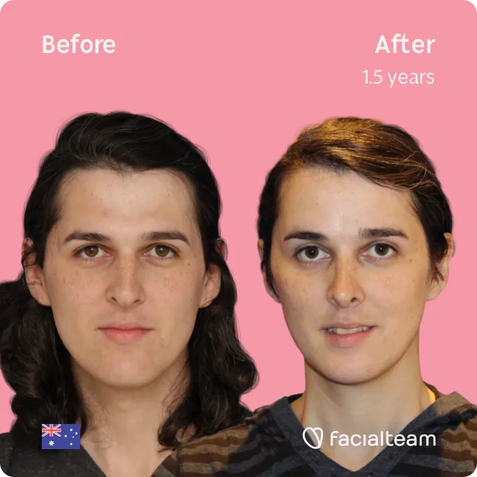 Square frontal image of FFS patient Allison showing the results before and after facial feminization surgery with Facialteam consisting of forehead, rhinoplasty, jaw and chin, tracheal shave feminization surgery.