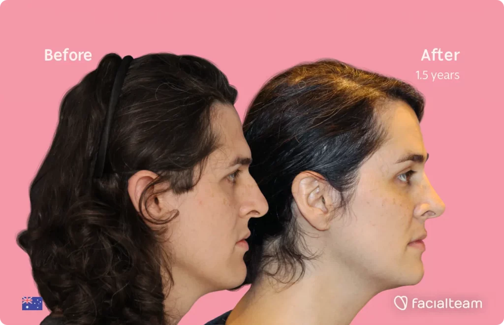 Side image of FFS patient Allison showing the results before and after facial feminization surgery with Facialteam consisting of forehead, rhinoplasty, jaw and chin, tracheal shave feminization surgery.